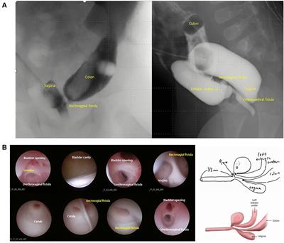 Case report: Magnetic resonance imaging-based three-dimensional printing for reconstruction of complex cloacal malformations